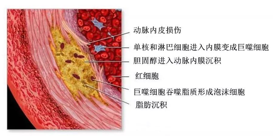 动脉粥样硬化发生的关键是脂代谢紊乱,脂质在血管内皮下沉积,主要是低