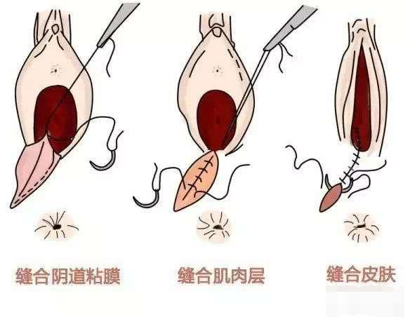 顺产撕裂缝针需要拆线吗说出来你都不一定会信涨知识了