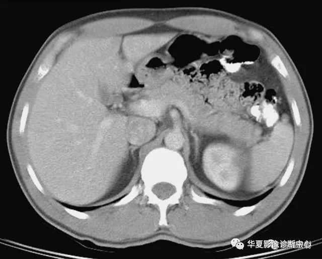 腹部ct基础读片36张,看完就会了!
