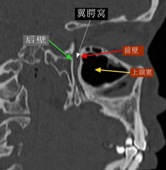 影像解剖:翼腭窝的ct影像解剖|蝶骨|上颌|后下|于翼