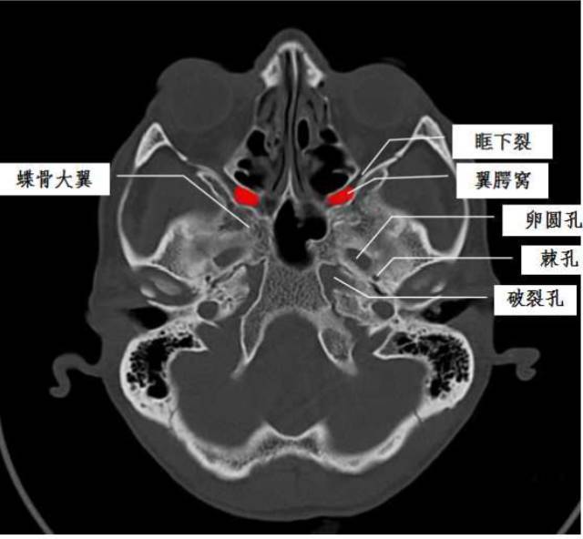 一文搞懂复杂解剖:翼腭窝|上颌|蝶骨|后下|于翼