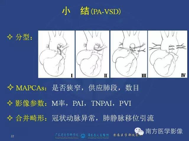 肺动脉闭锁合并室间隔缺损