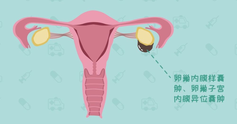 其实巧克力囊肿它是子宫内膜异位症的一种常见类型,学名是 卵巢子宫