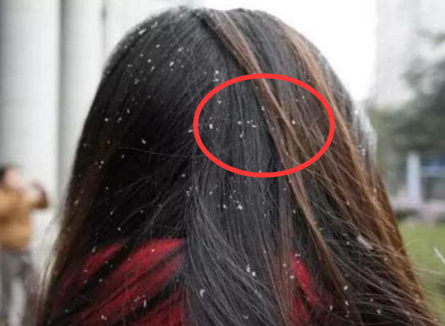 头皮上抠下"白色颗粒物"?专家:逃不过这"3点原因",别