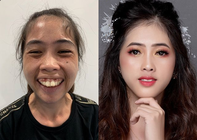 龅牙女孩曾因长得丑被嘲笑患抑郁症,如今整容成功判若