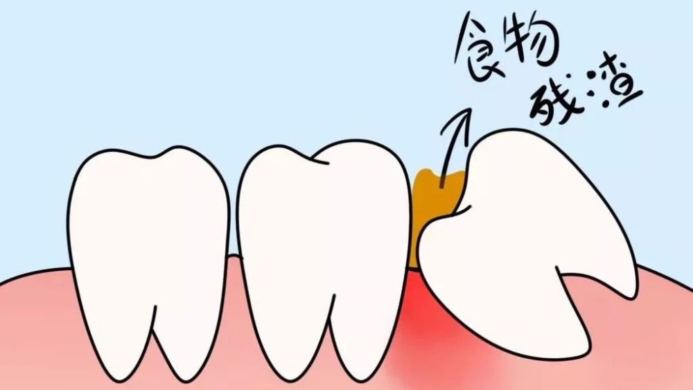 但是一旦智齿萌出有问题,位置不正或者造成临牙疼痛,龋齿等,就需要