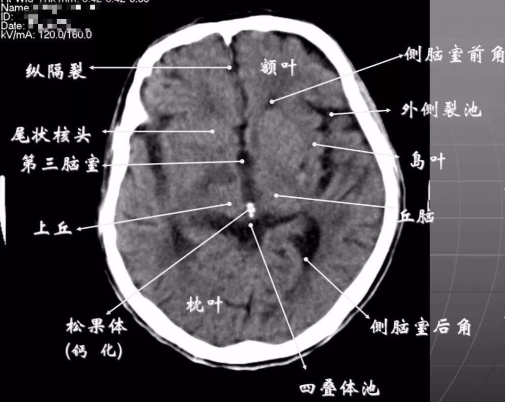 四叠体池:两侧枕叶之间,池内有松果体,向前与第三脑室连接.