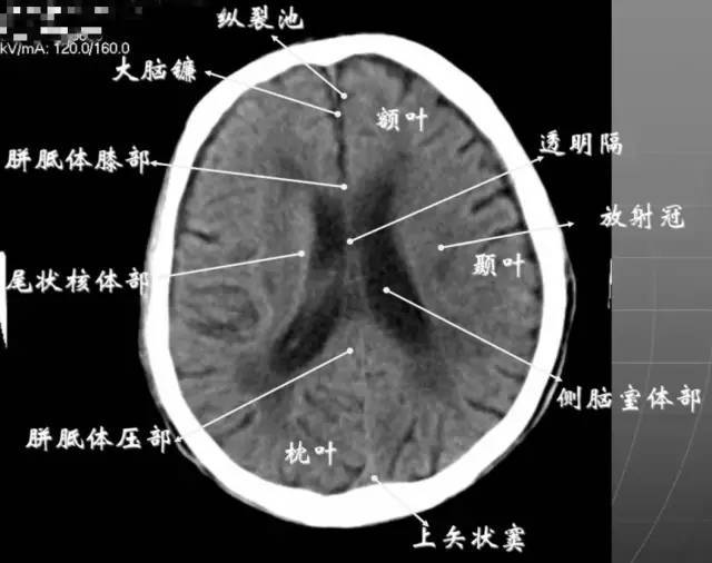 白质部分为半卵圆中心,额叶范围缩小,顶叶所占比例扩大,枕叶基本消失.