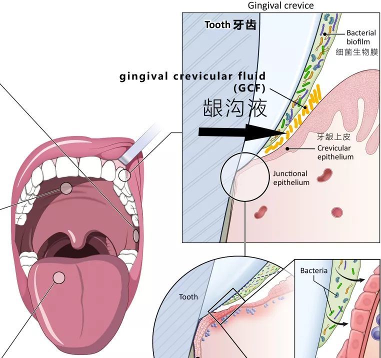 龈沟液(gcf)主要来自血清,被动地通过黏膜和牙龈裂缝转移到口腔.