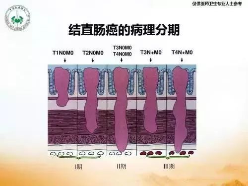 结肠癌外科手术大体经历了开腹手术