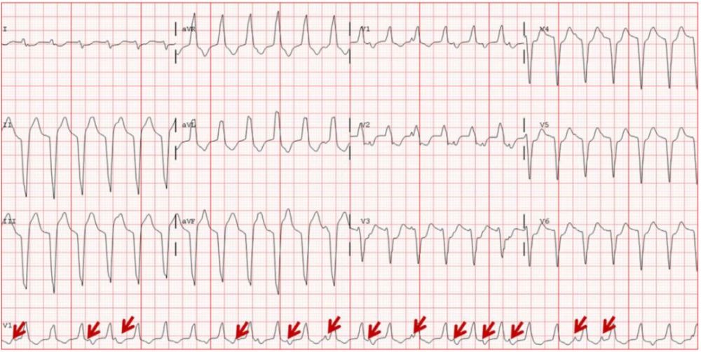 讲解洋地黄中毒,这是我见过最有趣的心电图!