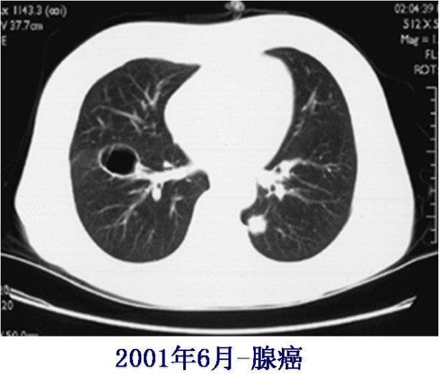 这十大肺部ct征像,一定有你不知道的!影像人