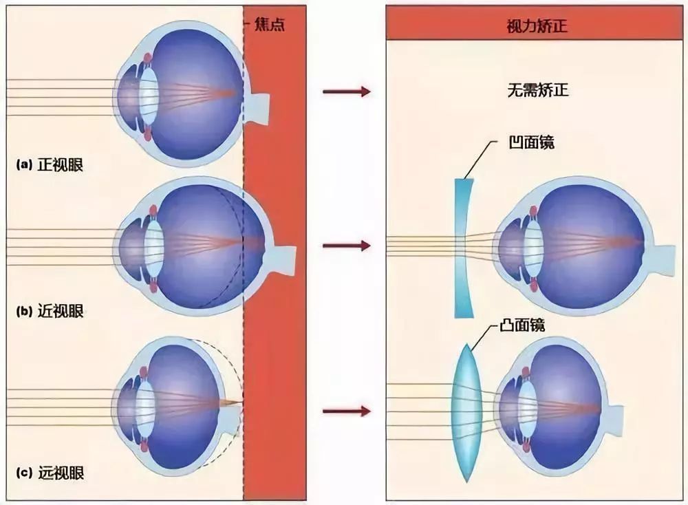 近视能抵消老花?别被以毒攻毒的思想误导了