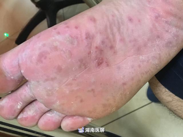手脚现红色疱疹误以为是脚气不料是儿子传染的手足口病