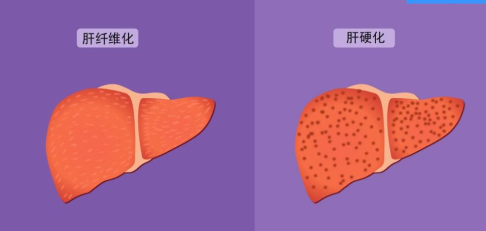 科普:肝纤维化和肝硬化有什么区别?