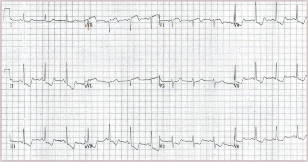 心电图显示st段下斜型压低,你是这样诊断的吗?