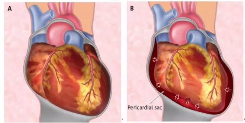 心肌梗死时,心肌软化,在血流冲击下,也可以出现心脏破裂,是心梗的重要