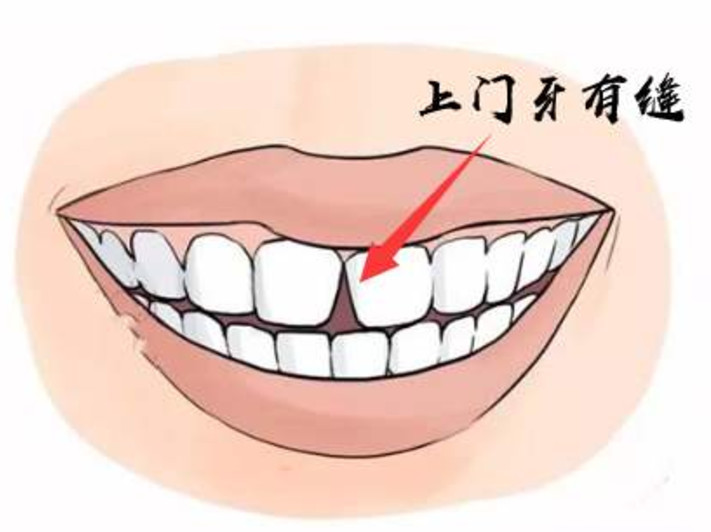 为什么牙齿缝隙越来越大?口腔医生:你的牙龈可能"坏了"