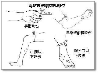 3,可以及时用鞋带,衣物等在伤口接近心脏一端或上一关节处用带子缚扎