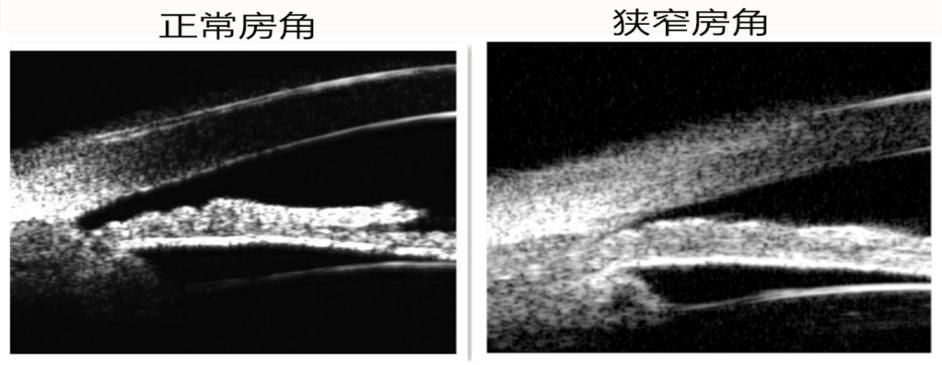 眼压高就是青光眼吗?