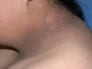 收藏!4 种内分泌疾病的皮肤表现