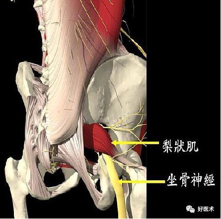 梨状肌综合征的解剖评估诊断