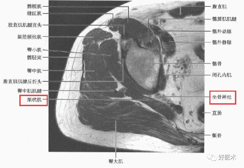 3,梨状肌周围断层解剖2,梨状肌周围结构坐骨神经是人体最粗大的神经