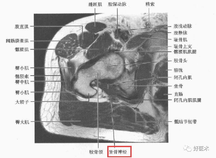 梨状肌综合征的解剖,评估,诊断