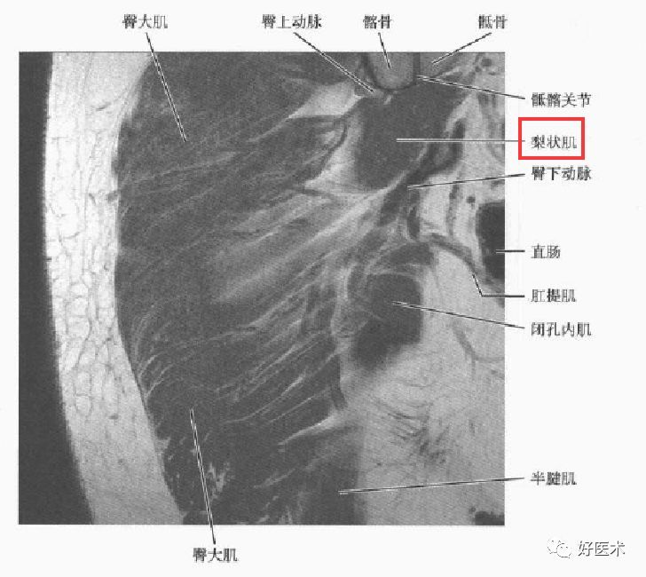 梨状肌综合征的解剖,评估,诊断