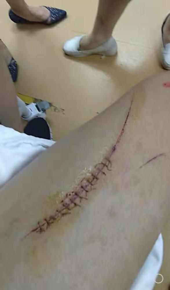 广州一男孩在酒店洗澡,途中浴室玻璃门爆破大腿被割伤