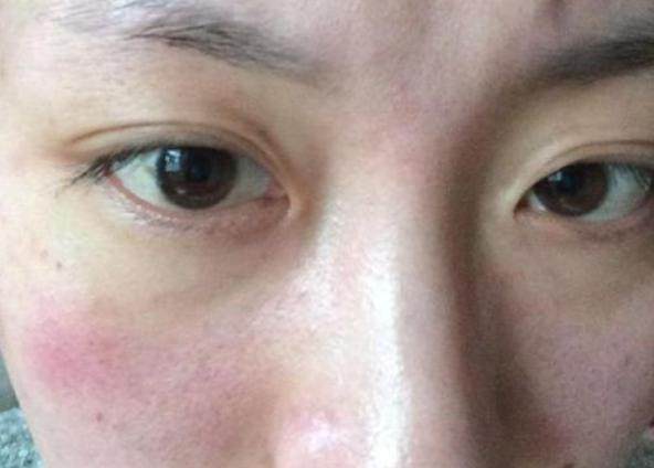 肝病也会上脸提醒肝脏不好的人脸上往往有这4种表现