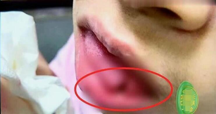 孩子舌头被划伤,缝8针索赔10万遭拒,口腔医院:无法协商
