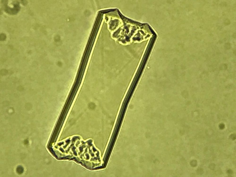 尿酸钠结晶是同类不同形态的尿酸结晶,为酸性盐类结晶,在强酸性尿液中