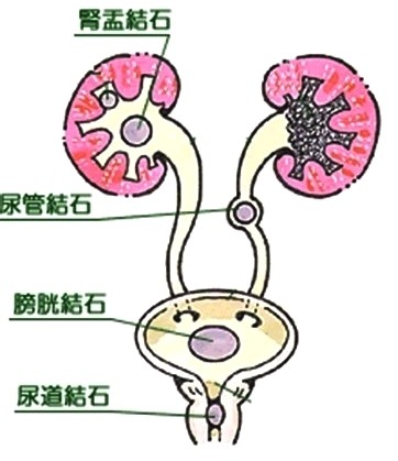 远离肾结石你需要做到这些!