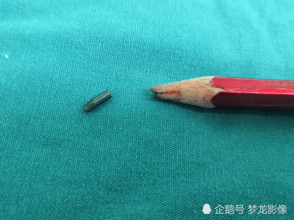 吓哭!武汉女子抱1岁儿子下楼 摔了一跤铅笔插入孩子颈部