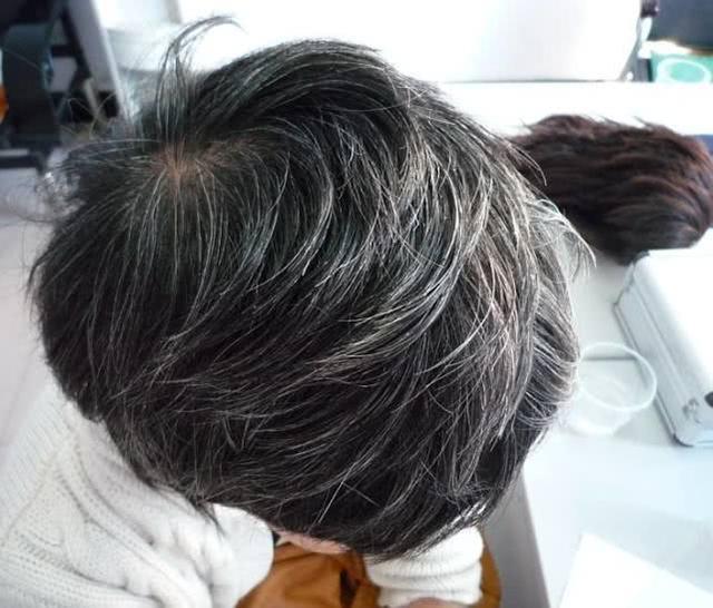 白头发增多或许是这3种营养素缺乏了补回来或许有变黑的可能