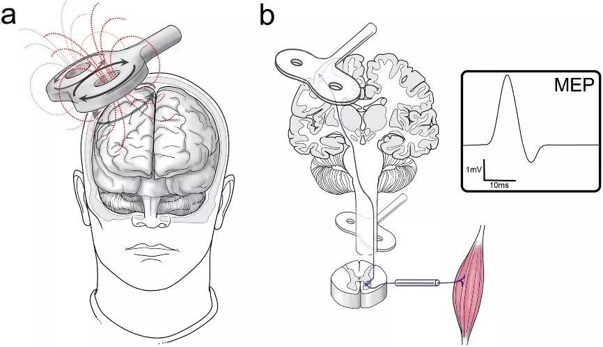 技术| 最"科学"的磁疗方法:经颅磁刺激