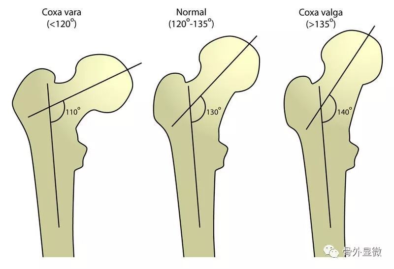 在女性中,由于骨盆宽度增加,股骨颈部与身体形成的角度比男性更接近