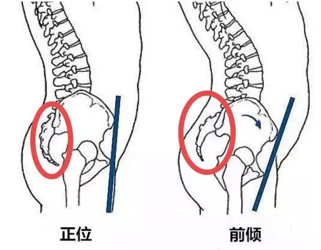 腰椎曲度过大就是骨盆前倾吗?不一定!