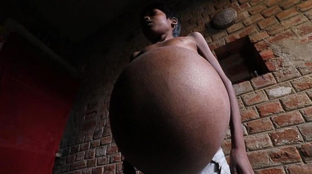 男子患离奇怪病:肚子变得越来越大,身体膨胀如气球