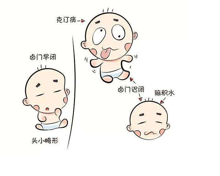 怀孕补钙不补碘孩子出生可能会患呆小症