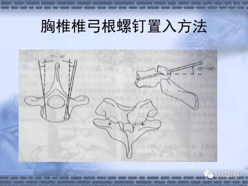 掌握丨椎弓根螺钉多种定位方式