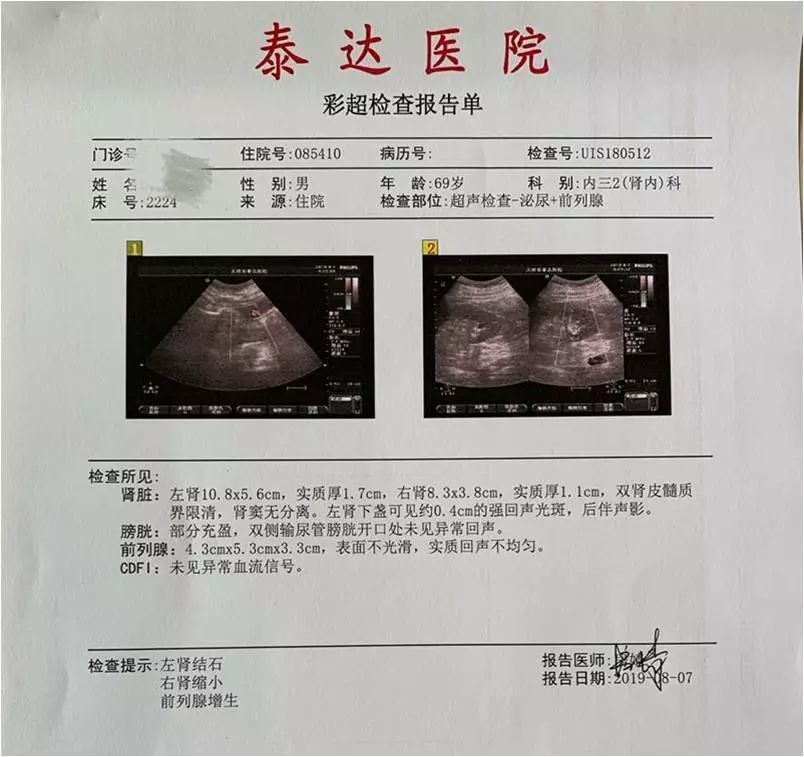 4ml/min,右肾功能15.23ml/min.