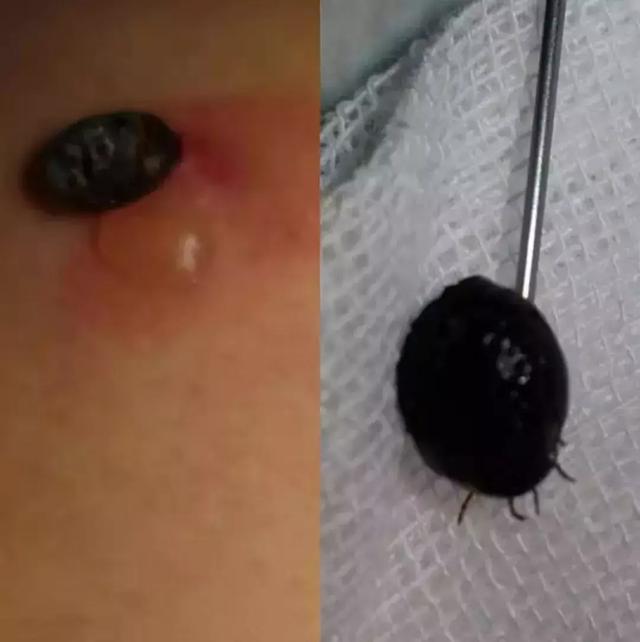 被蜱虫叮咬处的皮肤已红肿,出水泡(左)从病人身上取出活体蜱虫(右)