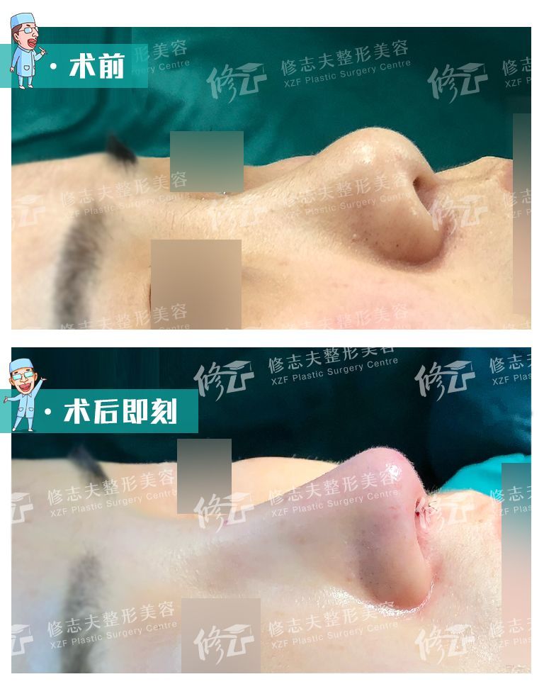 鞍鼻可做个假体隆鼻,而驼峰鼻则可以磨掉或削去驼峰进行矫正