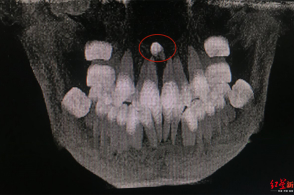 13岁男孩牙齿倒起长 "逆流而上"差点冲进鼻子