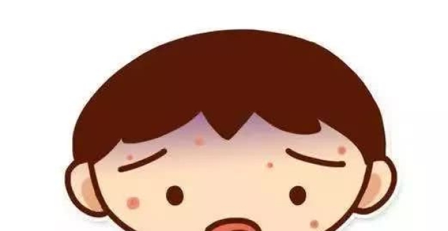 我今年28岁,刚出完水痘,想给所有成年人提个醒:成年人也会得水痘哒