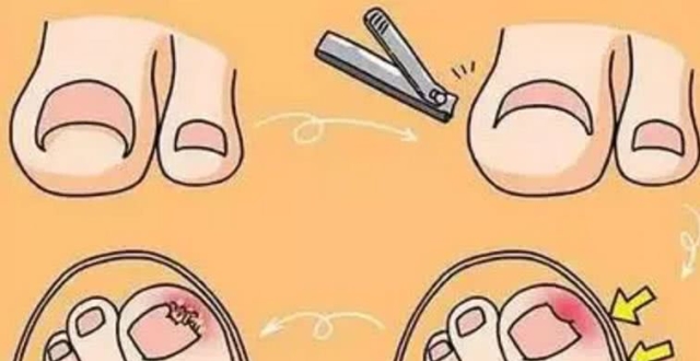 剪出甲沟炎?预防甲沟炎应该这么做
