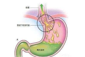 反流性食管炎有3大症状,治疗方法有3种