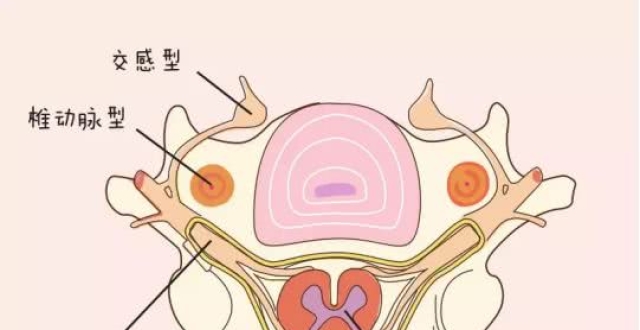 显微镜下颈椎前路acdf治疗脊髓型颈椎病